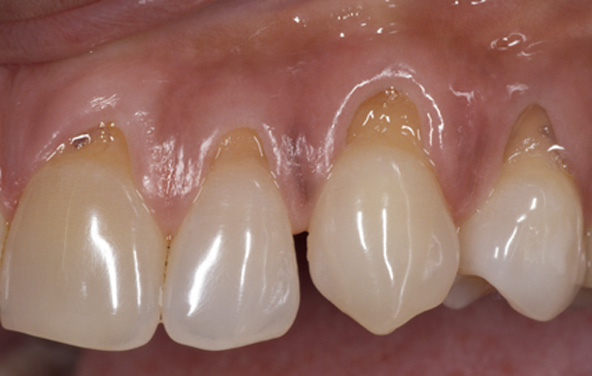 Gum Treatment - Seattle Specialty Dentistry