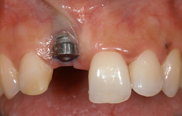 PG-ImplantCrowns-4a