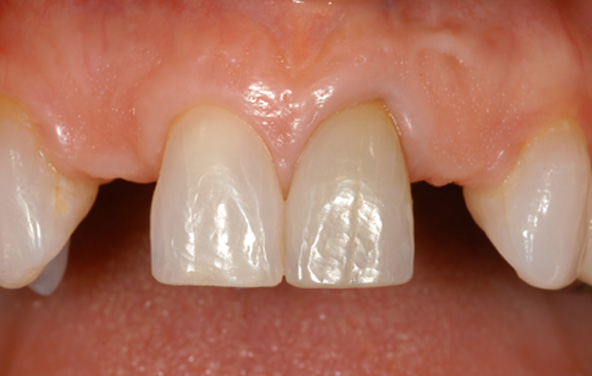 PG-ImplantCrowns-5a