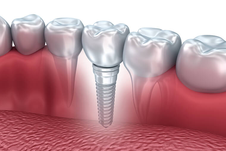 Image showing a single dental implant in place