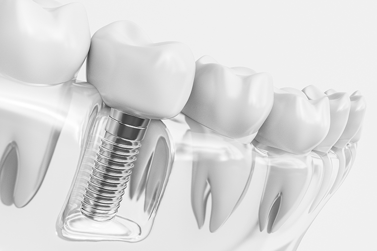 A clear plastic model displaying a dental implant inside a gum