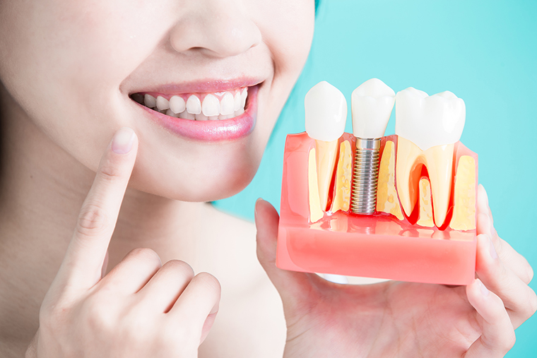 A female smiling and holding a dental implant model in a gum.
