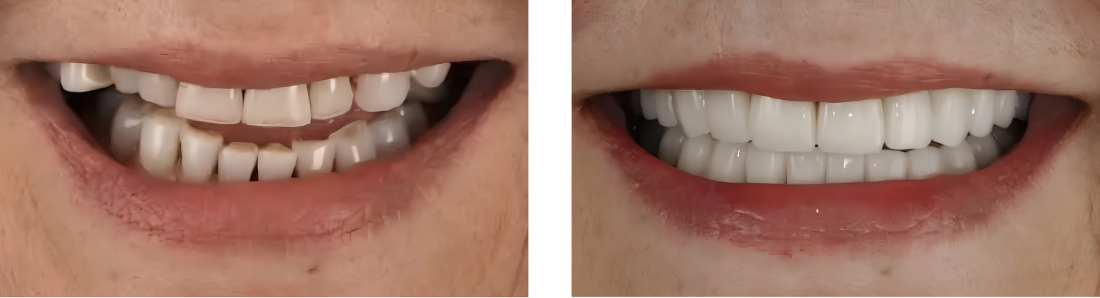 A split screen of the before and after smiles