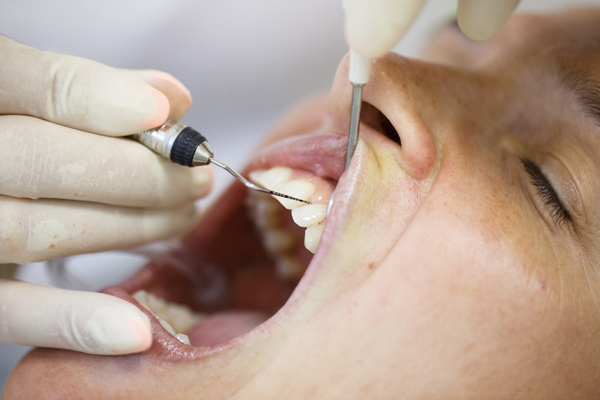 tips for choosing implant dentist