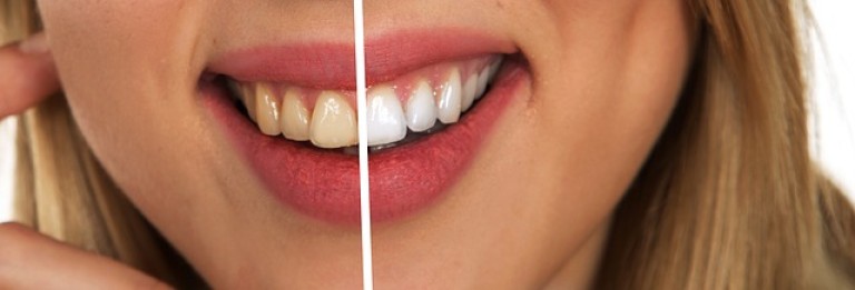 summer smile makeover