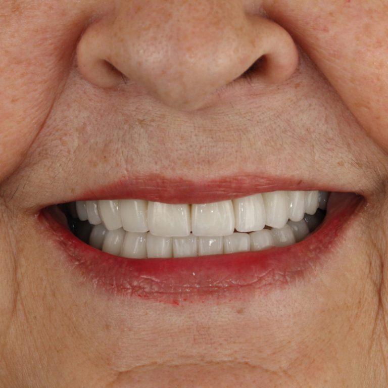 Full mouth reconstruction with Seattle Specialty Dentistry