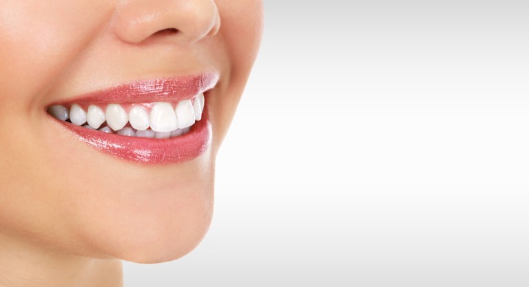 dental veneers