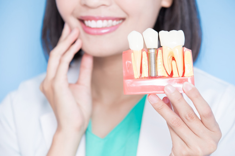 dental implants in seattle