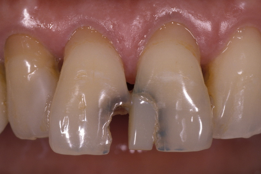 Composite-Fillings-4-1_resize1