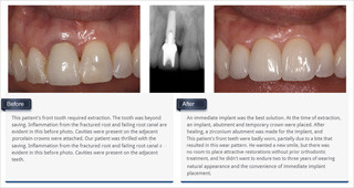 thumb_implant_crowns
